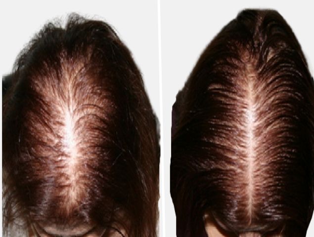 vypadávání vlasů u žen léčba