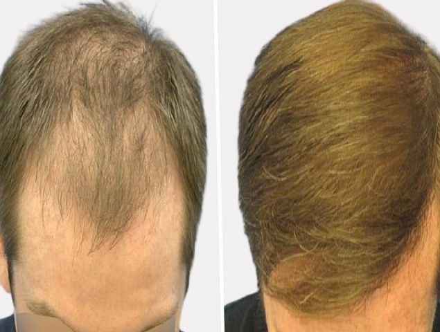 vypadávání vlasů u mužů léčba