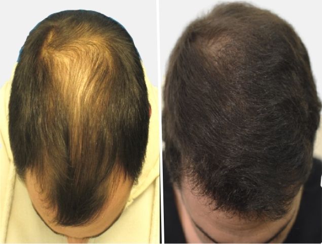 vypadávání vlasů u mužů léčba